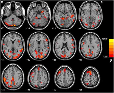 Disrupted Regional Homogeneity in Major Depressive Disorder With Gastrointestinal Symptoms at Rest